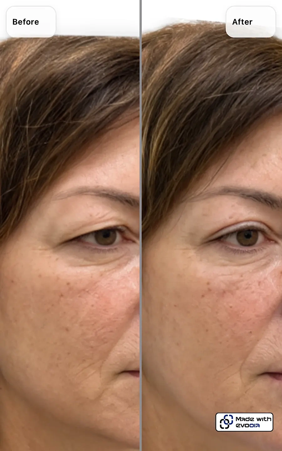 Before-and-after patient photo comparison in the evooia app (Side-by-side)